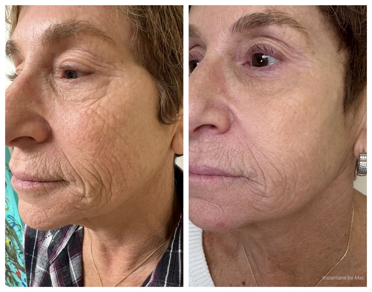 Non-surgical facelift NYC before and after — full face skin texture rejuvenation and lifting with the Dr. G Lift by Dr. Alexander GolBerg Manhattan