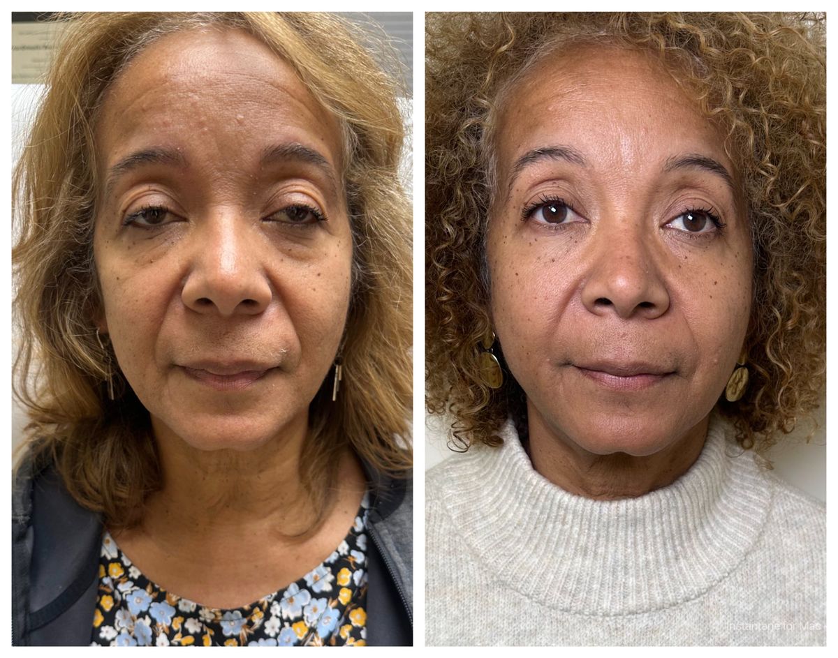 Non-surgical facelift Manhattan before and after — facial definition jawline lift results Dr. G Lift Upper East Side NYC