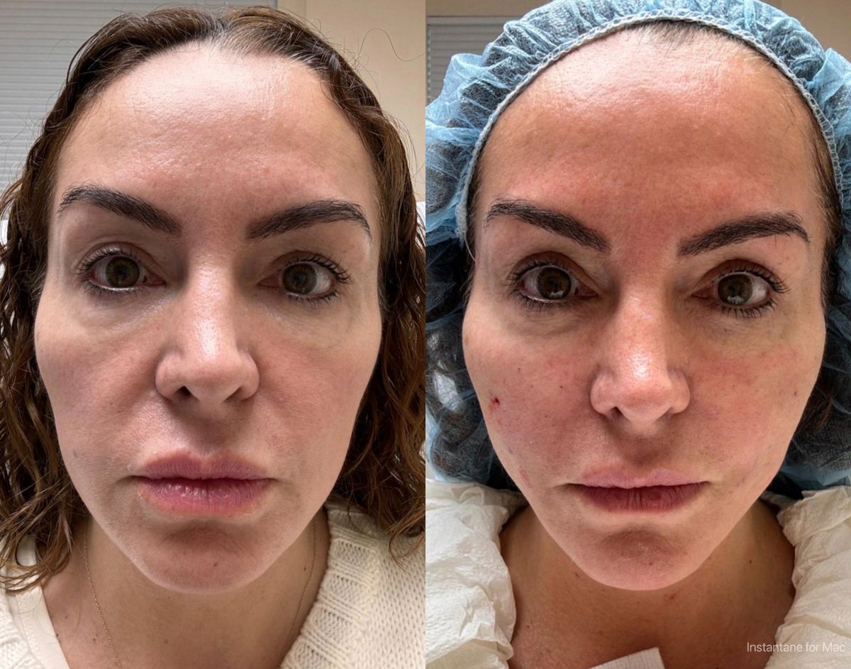 Jowl treatment NYC before and after — lower face sagging lift non-surgical facelift results Dr. GolBerg Manhattan