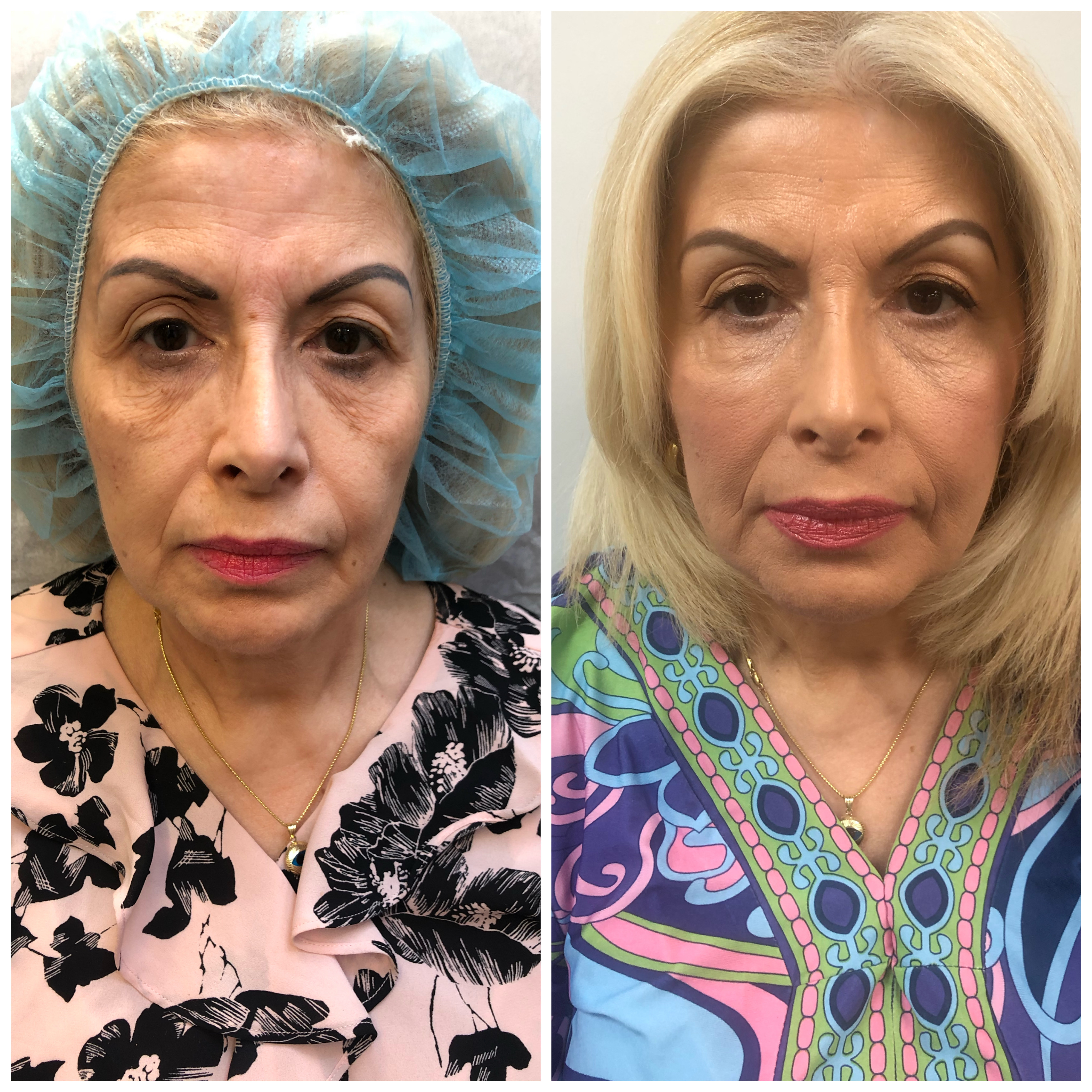 Non-surgical facelift NYC before and after — skin texture and tone improvement with the Dr. G Lift by Dr. Alexander GolBerg Manhattan