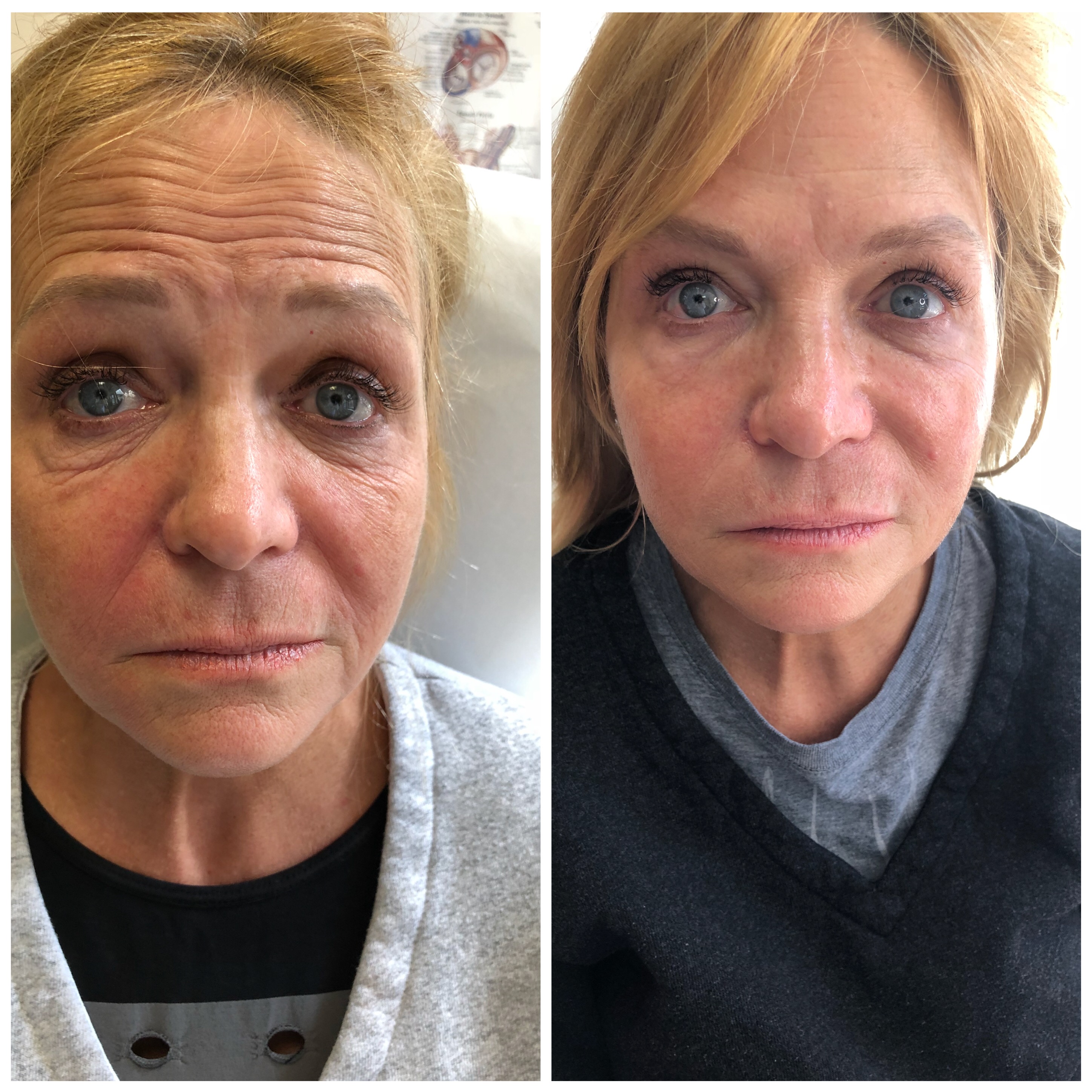 Non-surgical facelift Manhattan before and after — cheek and midface lift results Dr. G Lift Upper East Side NYC