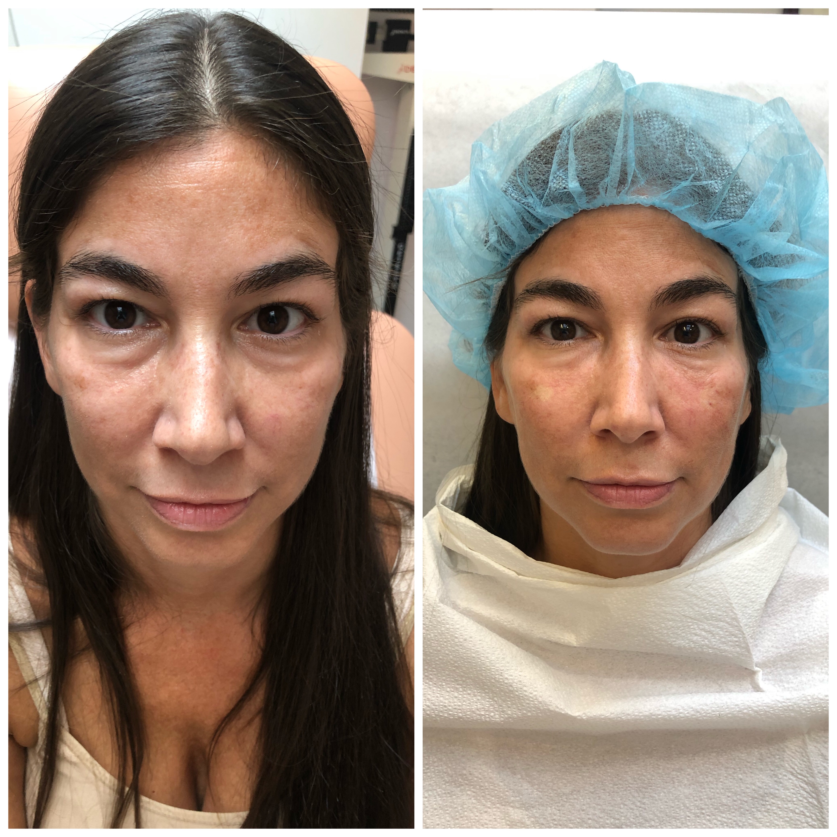 Non-surgical facelift NYC before and after — natural facial rejuvenation and radiance results Dr. GolBerg Manhattan