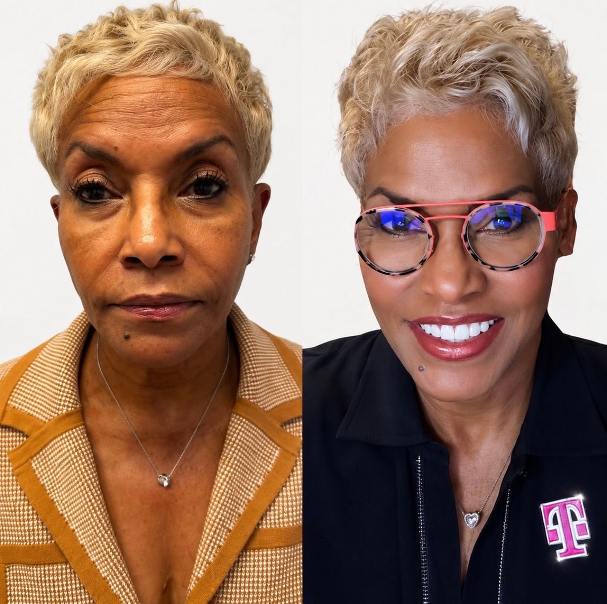 Non-surgical facelift NYC before and after — facial refresh, softened folds and radiant skin with the Dr. G Lift by Dr. Alexander GolBerg Manhattan