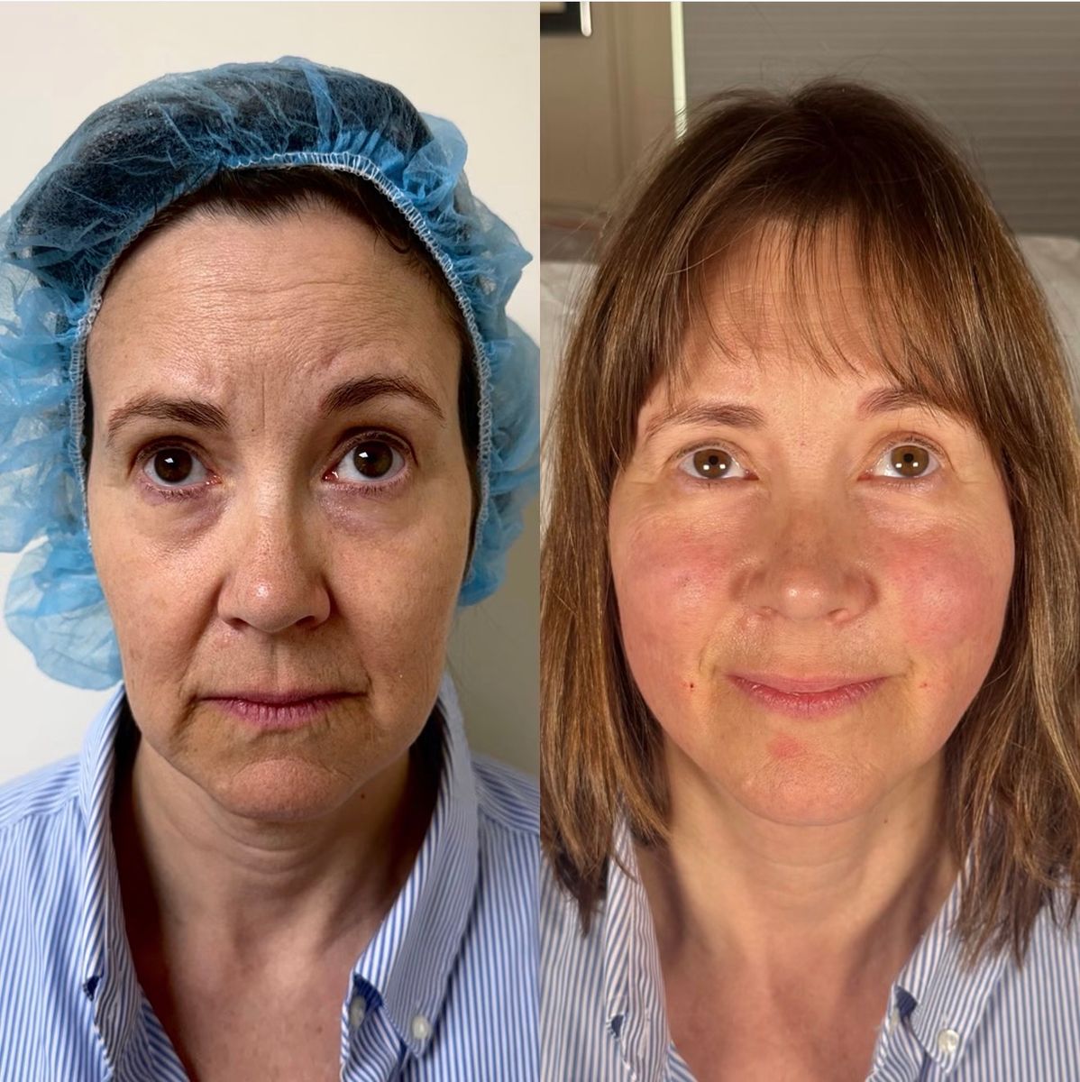Non-surgical facelift Manhattan before and after — forehead lines and under-eye rejuvenation results Dr. G Lift Upper East Side NYC
