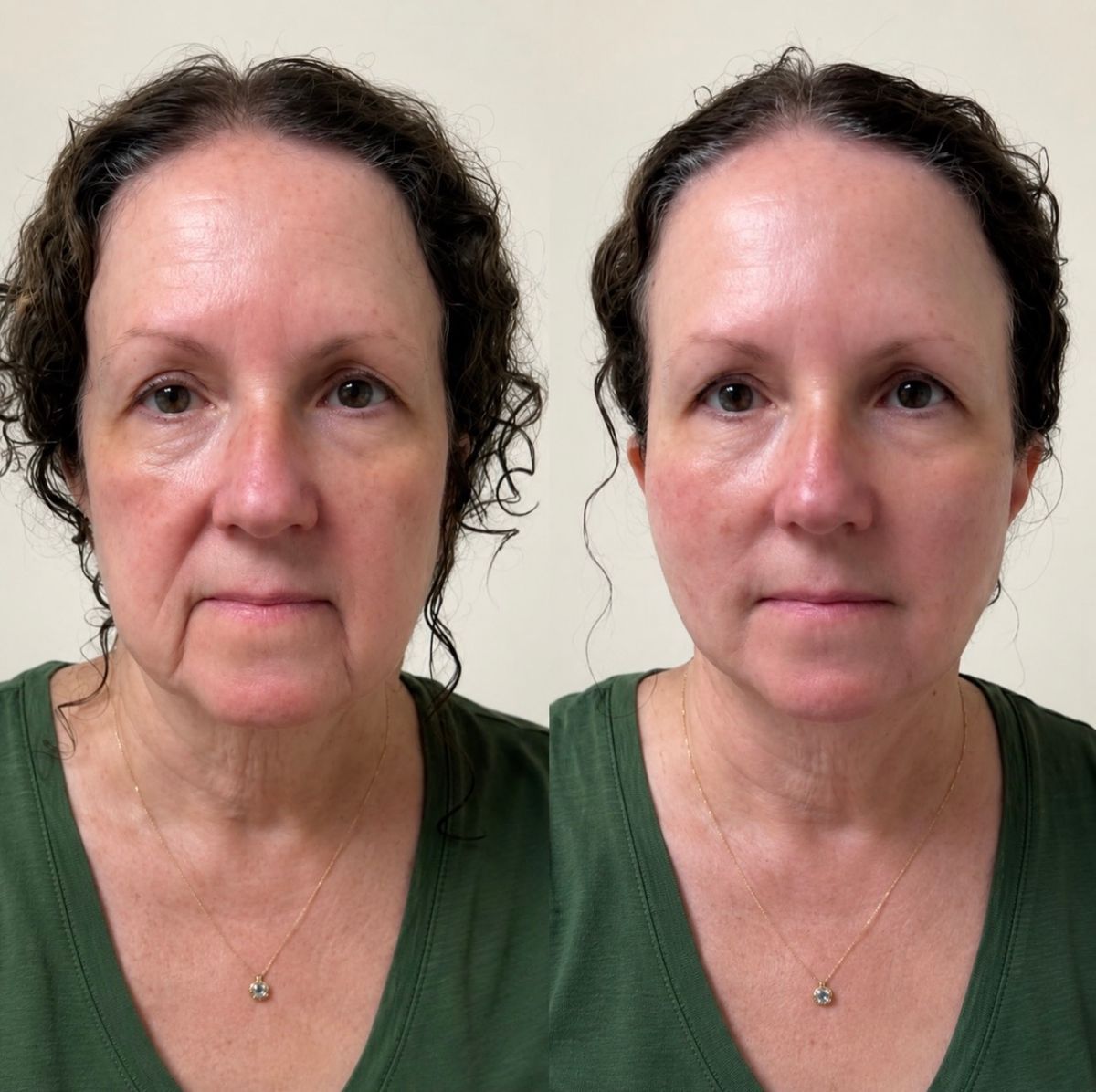 Jowl and marionette line treatment NYC before and after — jawline and neck lift non-surgical facelift results Dr. GolBerg Manhattan